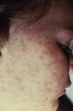 This image depicts the characteristic rash that had been caused by Rocky Mountain spotted fever.
